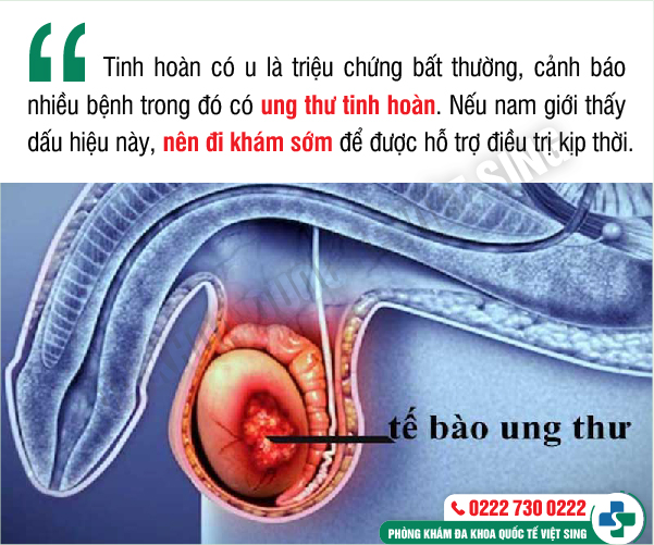 https://phongkhamdakhoavietsing.vn/wp-content/uploads/2023/06/1-tinh-hoan.jpg