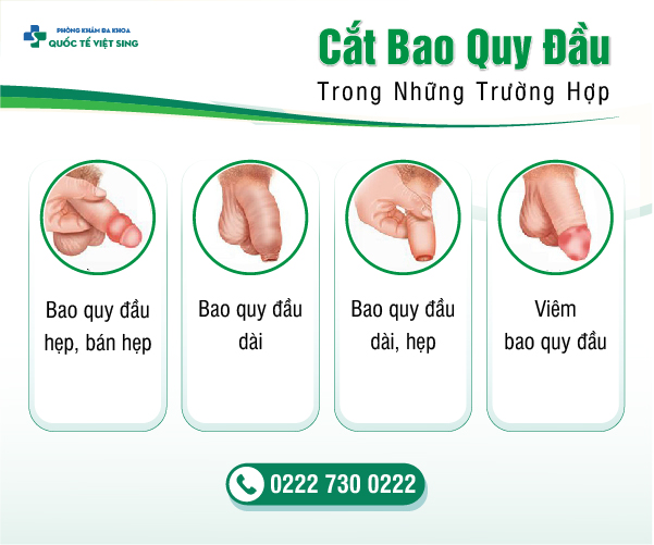 https://phongkhamdakhoavietsing.vn/wp-content/uploads/2023/06/doi-tương-cắt-bqd.jpg