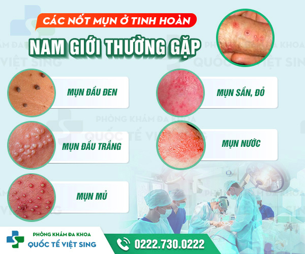 https://phongkhamdakhoavietsing.vn/wp-content/uploads/2023/06/mun-tinh-hoan.jpg