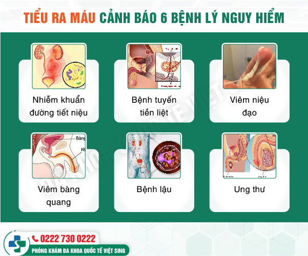 Nguy cơ UNG THƯ TIẾT NIỆU khi để tiểu buốt, tiểu rắt, tiểu ra máu tự khỏi