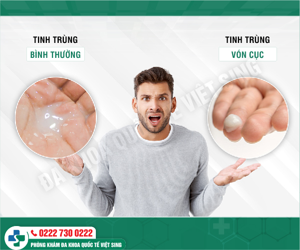Tinh trùng vón cục – nguyên nhân dẫn đến vô sinh ở 95% nam giới