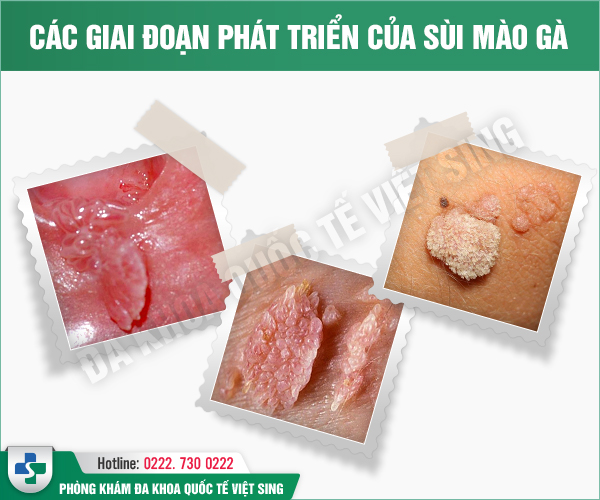 Dấu hiệu nhận biết sùi mào gà nữ điển hình – Việc điều trị có đơn giản không?