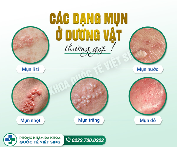 Bác sĩ chia sẻ về nguyên nhân dương vật nổi mụn đỏ và cách chữa hiệu quả