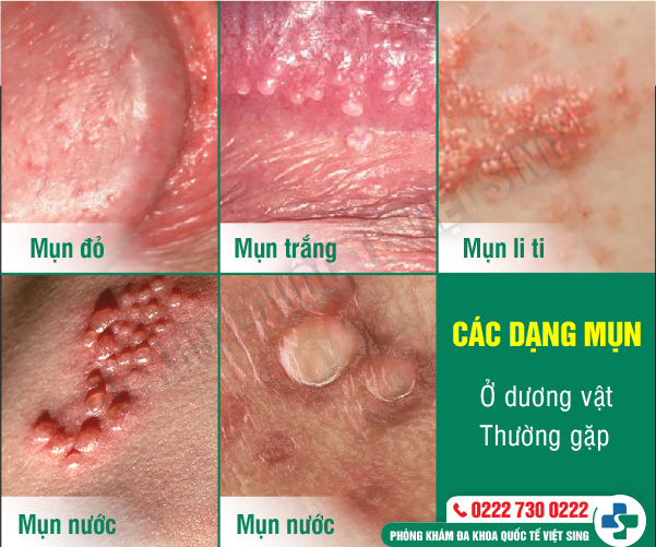 https://phongkhamdakhoavietsing.vn/wp-content/uploads/2023/07/mun-duong-vat.jpg