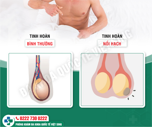 Tinh hoàn bị teo vì sao? Cách chữa teo tinh hoàn ở đâu hiệu quả
