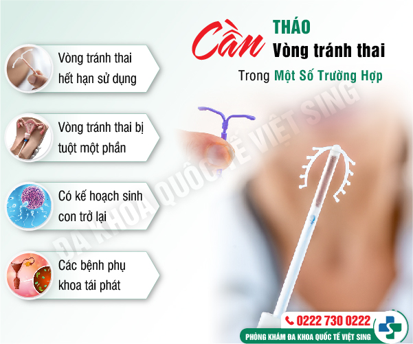 Tháo vòng tránh thai khi nào? Gợi ý địa chỉ thực hiện uy tín tại Bắc Ninh
