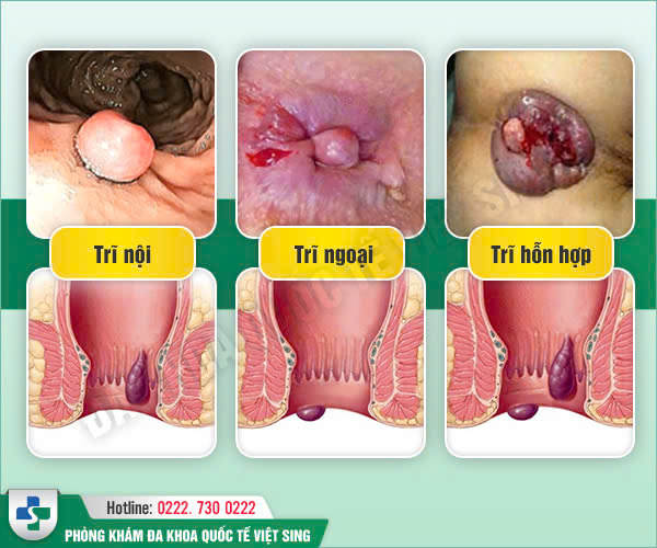 Review top 7 địa chỉ khám chữa bệnh trĩ tốt nhất tại tỉnh Bắc Ninh
