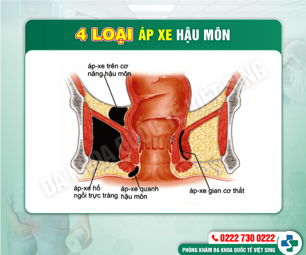 Cần nhận biết sớm triệu chứng bệnh apxe hậu môn điển hình