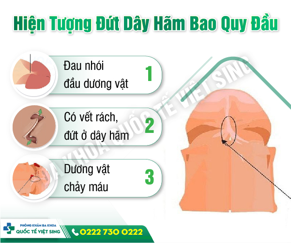 Đâu là cách chữa dây hãm bao quy đầu hiệu quả, an toàn hiện nay?