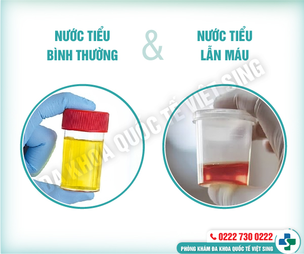Nữ giới đi tiểu ra máu sau quan hệ cảnh báo bệnh lý nguy hiểm cần chữa ngay
