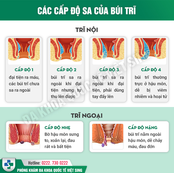 Sa Búi Trĩ: Nguyên Nhân Và Cách Chữa Hiệu Quả