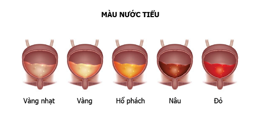 Nước tiểu có màu đỏ, hồng, nâu,… bất thường là bị làm sao? Có nguy hiểm không?