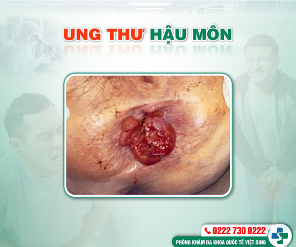 Hoang mang khi thấy đau hậu môn mà không biết là bệnh gì?