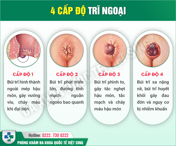 Các cấp độ của bệnh trĩ ngoại: Phát hiện muộn nguy cơ ung thư trực tràng