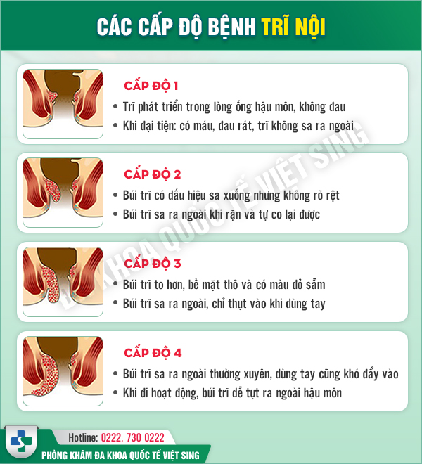 Bác sĩ giải đáp về các cấp độ của trĩ nội và khi nào cần cắt trĩ