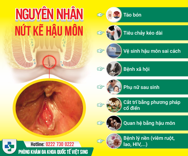 Cảnh giác ngay khi biết nguyên nhân gây nứt hậu môn!