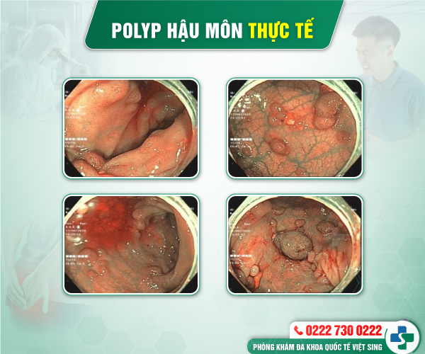 Báo giá chi phí chữa Polyp hậu môn mới nhất năm 2025