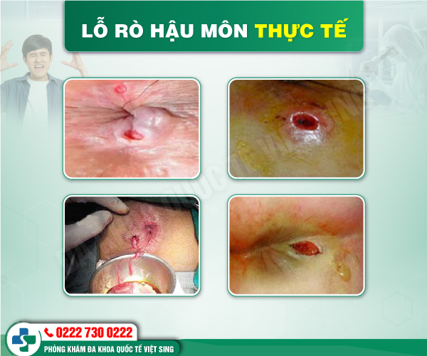 Chuyên gia cảnh báo: Chớ nên chủ quan với 5 dấu hiệu rò hậu môn điển hình