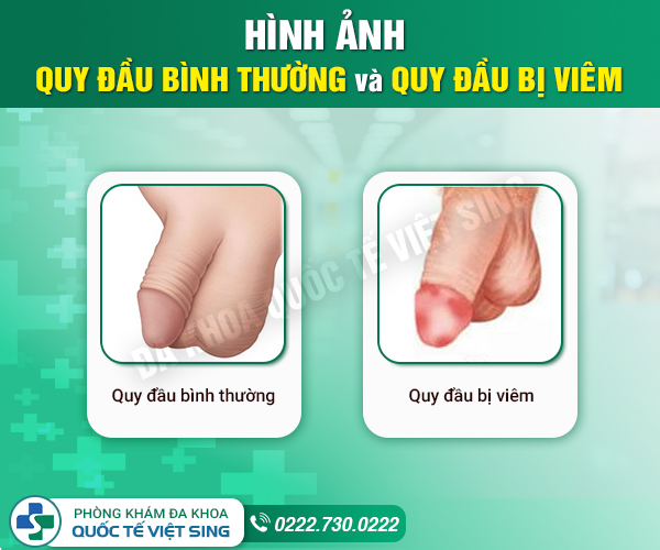 Nhận biết sớm 5 dấu hiệu viêm quy đầu? 90% nam giới bỏ qua bị biến chứng nguy hiểm