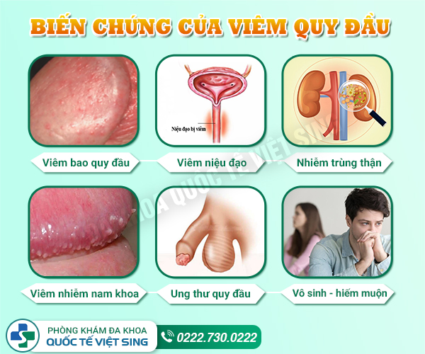 Viêm quy đầu có nguy hiểm không? Chữa thế nào để không bị vô sinh, hiếm muộn?