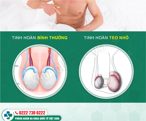 Nhận biết nguyên nhân tinh hoàn bị teo vì sao? Cách chữa bệnh thế nào?