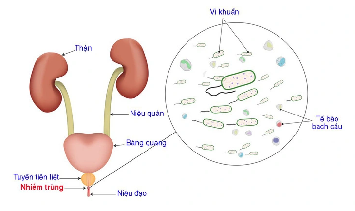 Nhận biết cực đơn giản dấu hiệu viêm niệu đạo ở nữ qua 5 triệu chứng sau