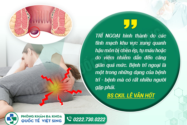 Phân biệt 4 cấp độ bệnh trĩ ngoại qua từng biểu hiện khác nhau