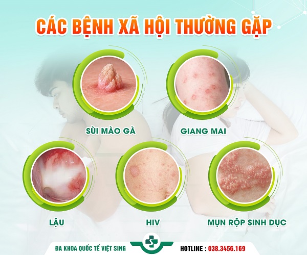 [Tất tần tật] Bệnh xã hội: Triệu chứng, nguyên nhân và phương pháp điều trị